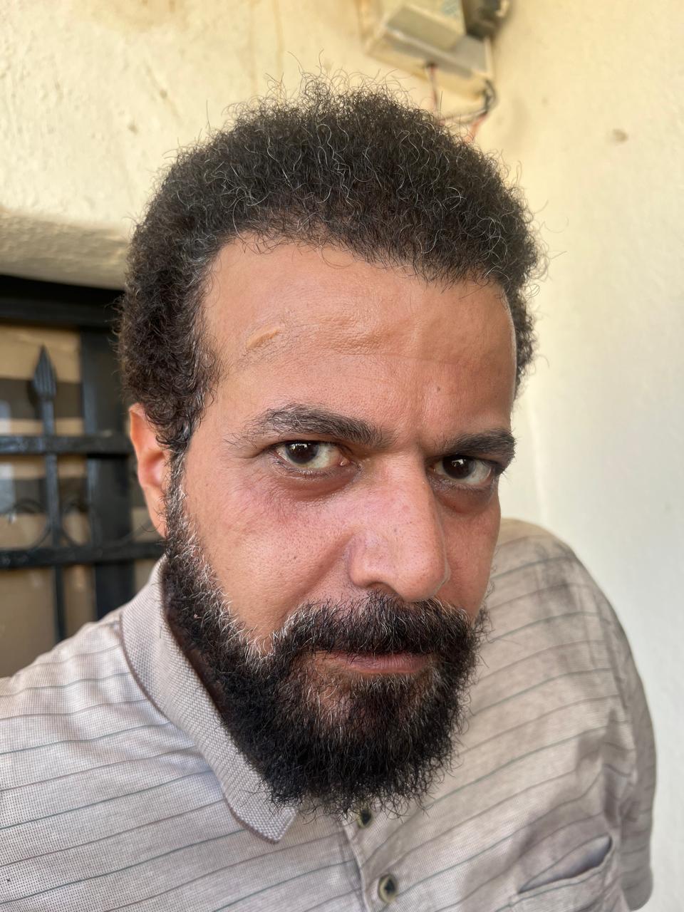Male character close-up, beard and hair visible, with under-eye shadowing and a raised-looking forehead mark.