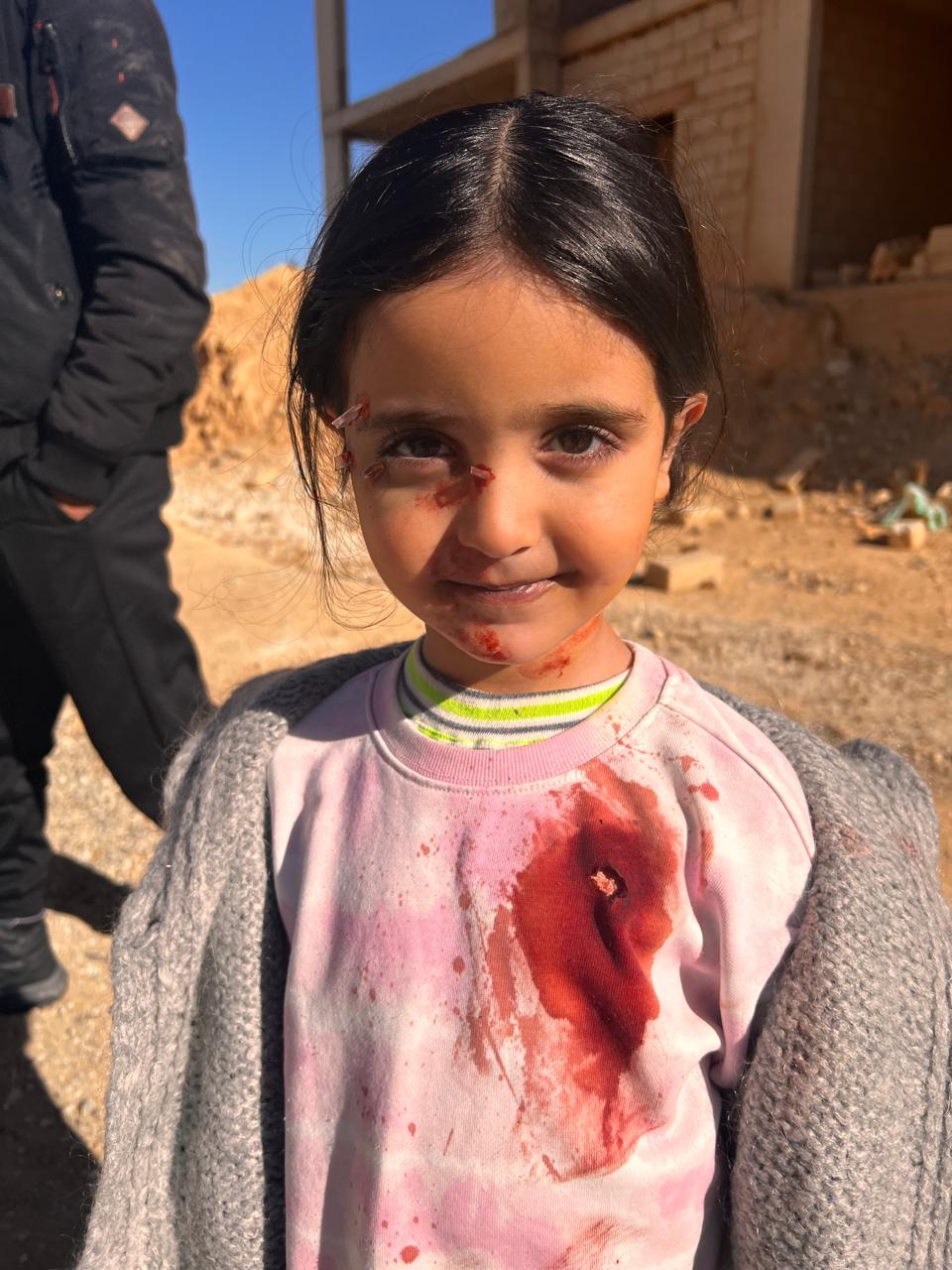 Child performer outdoors with red marks around one eye, nose, chin and neck; pink top with prominent red chest stain and small opening; gray outer layer.